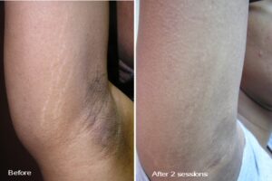 Stretch Mark Removal Toronto Clinic