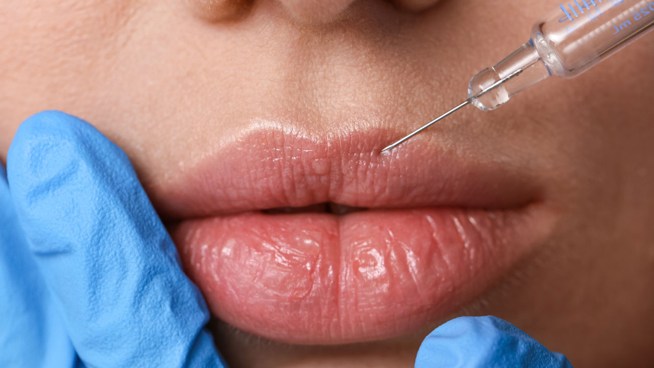 lip-filler-in-milton