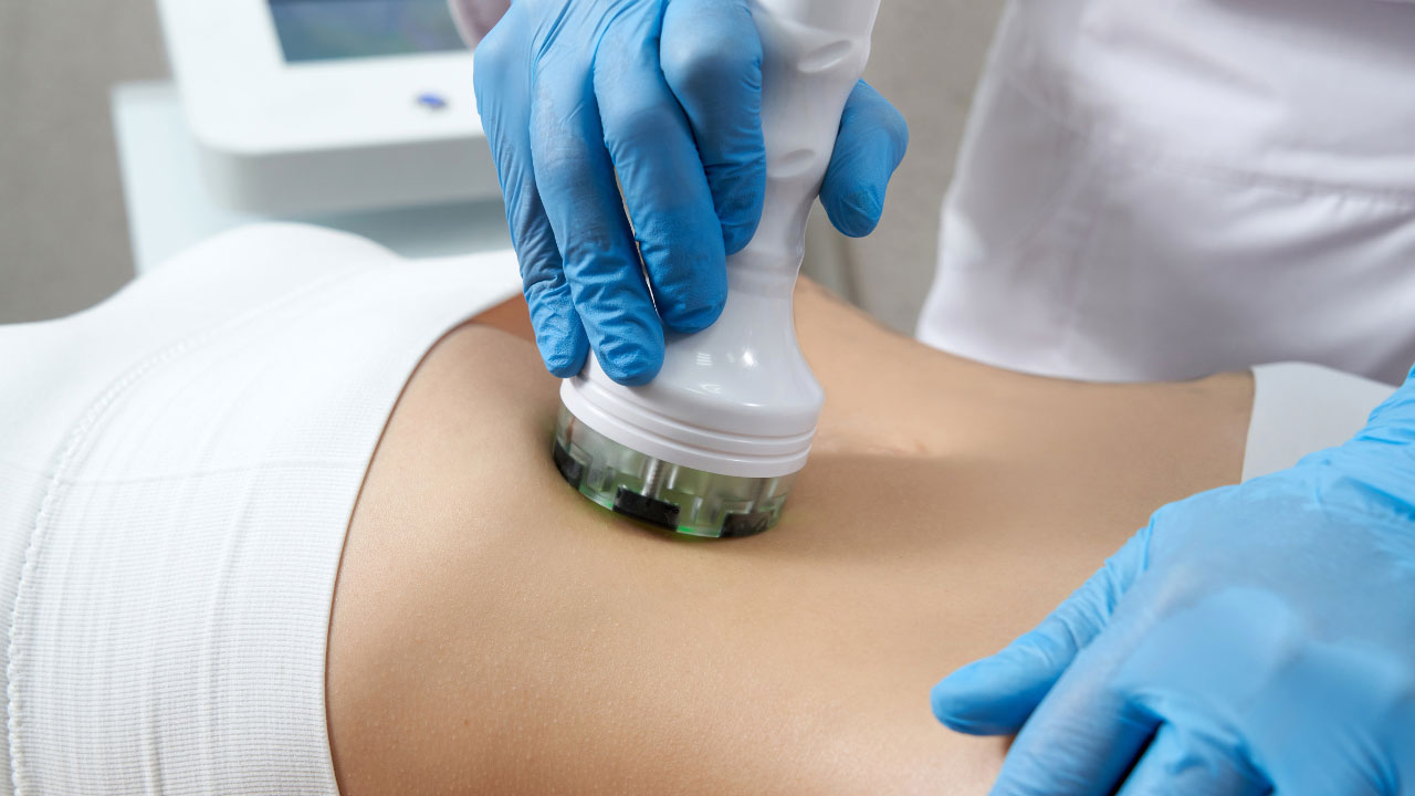 CoolSculpting in Etobicoke